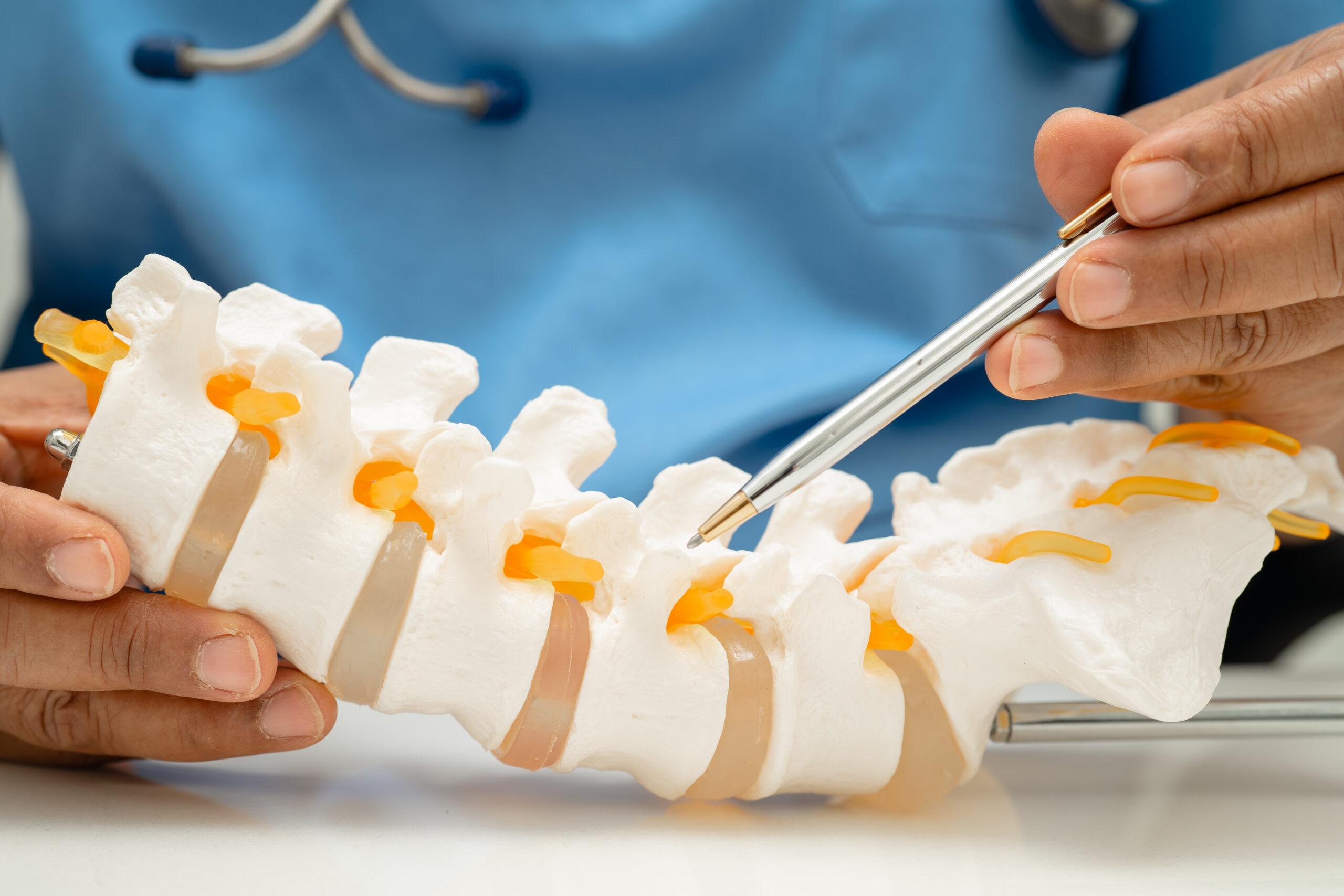 Asian doctor holding spinal nerve and bone model, Lumbar spine displaced herniated disc fragment for treatment medical in the orthopedic department.
