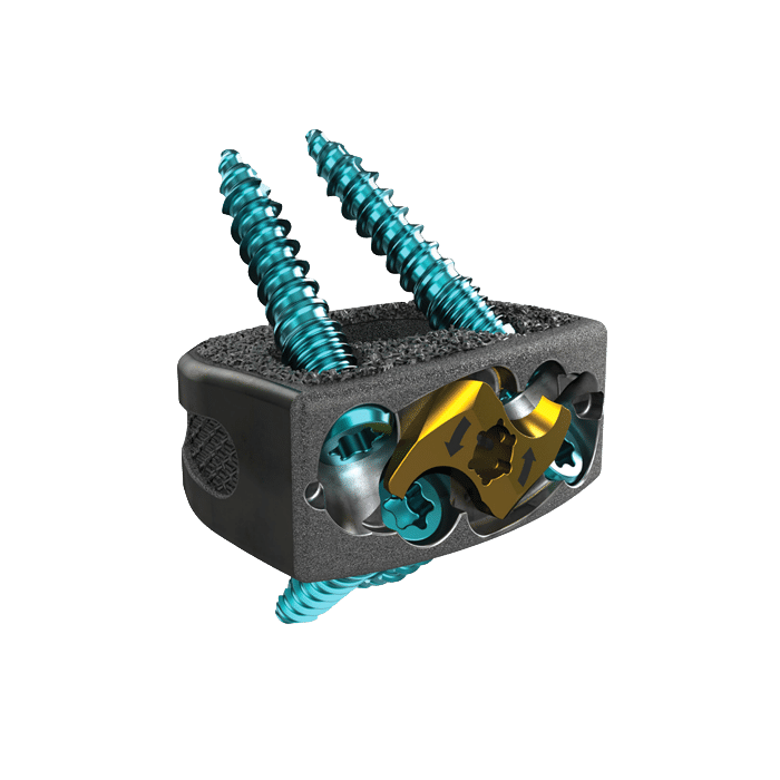 F3D ALIF Interbody System