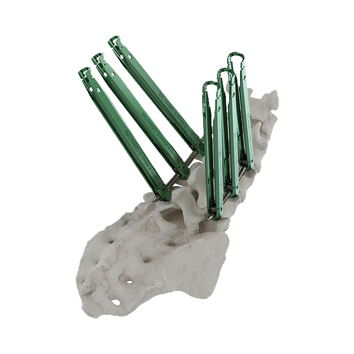 Thunderbolt ExTab Minimally Invasive Extended Tab Pedicle Screw System